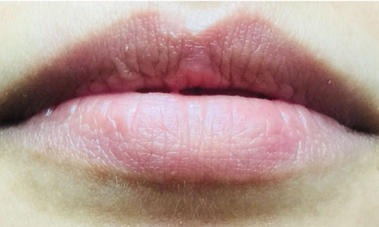 lip-fillers-natural