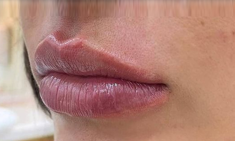 lip-filler-dissolving